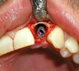 Clínica Dental Yarza implante inmediato 3