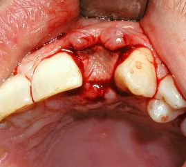 Clínica Dental Yarza implante inmediato 2