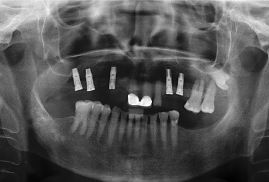 Clínica Dental Yarza rehabilitación con implantes 2