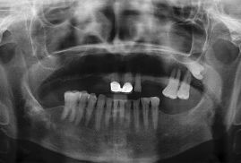 Clínica Dental Yarza rehabilitación con implantes 1