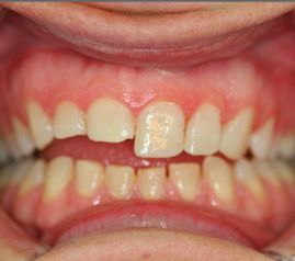 Clínica Dental Yarza reconstrucción estética 2