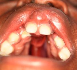 Clínica Dental Yarza ortodoncia prequirúrgica 1