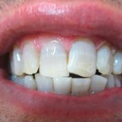 Clínica Dental Yarza blanqueamiento