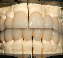 Clínica Dental Yarza protesis fija 8