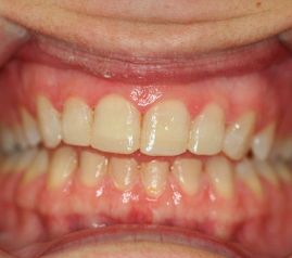 Clínica Dental Yarza reconstrucción estética 3